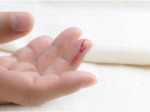 Hiện tượng bị đứt tay chảy máu theo góc độ khoa học