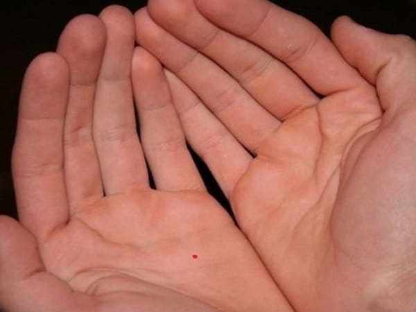 Nốt ruồi thị phi ở lòng bàn tay hoặc ngón tay